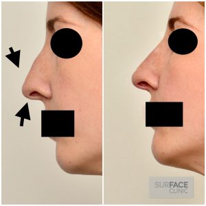 Nose Straightening