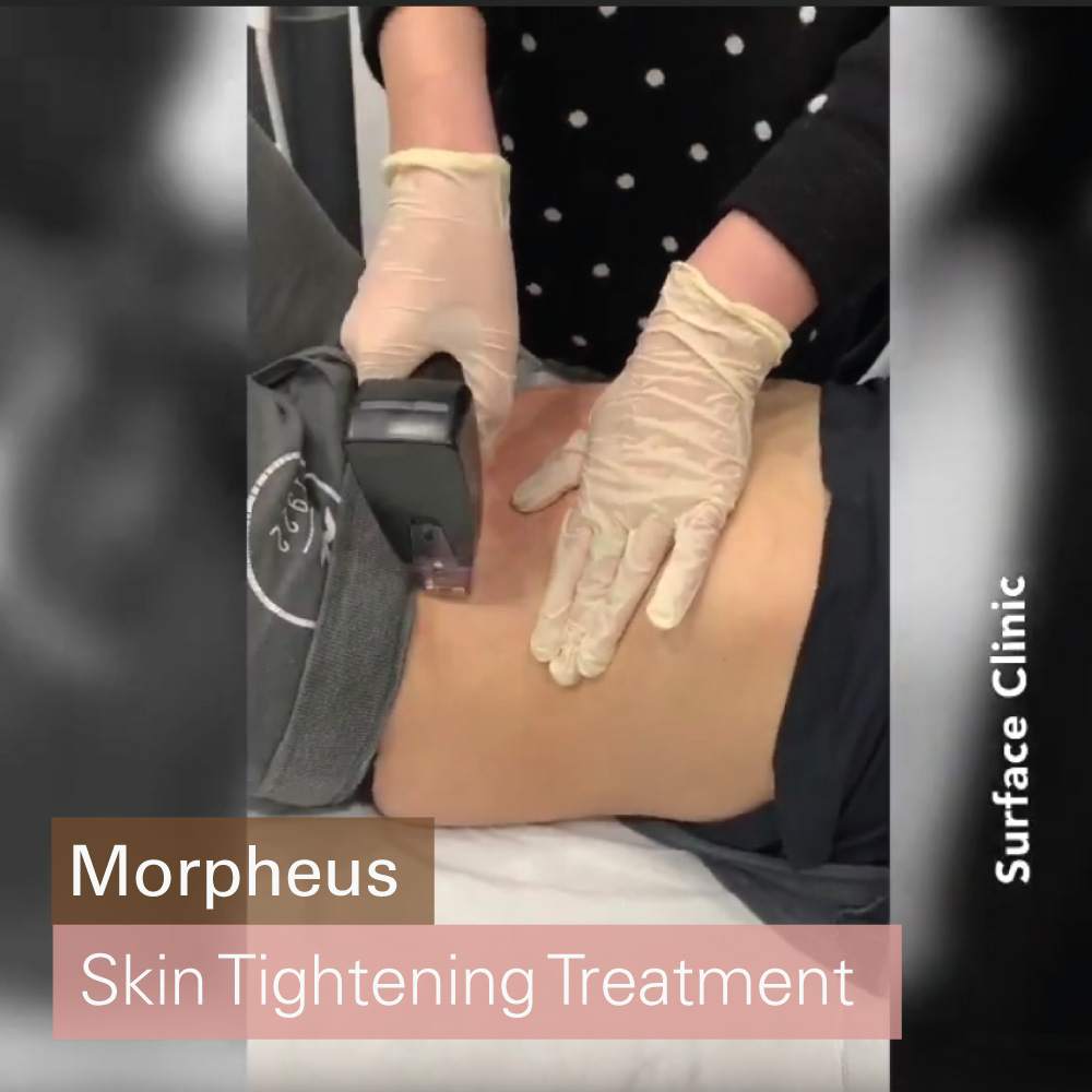 morpheus 8 treatment
